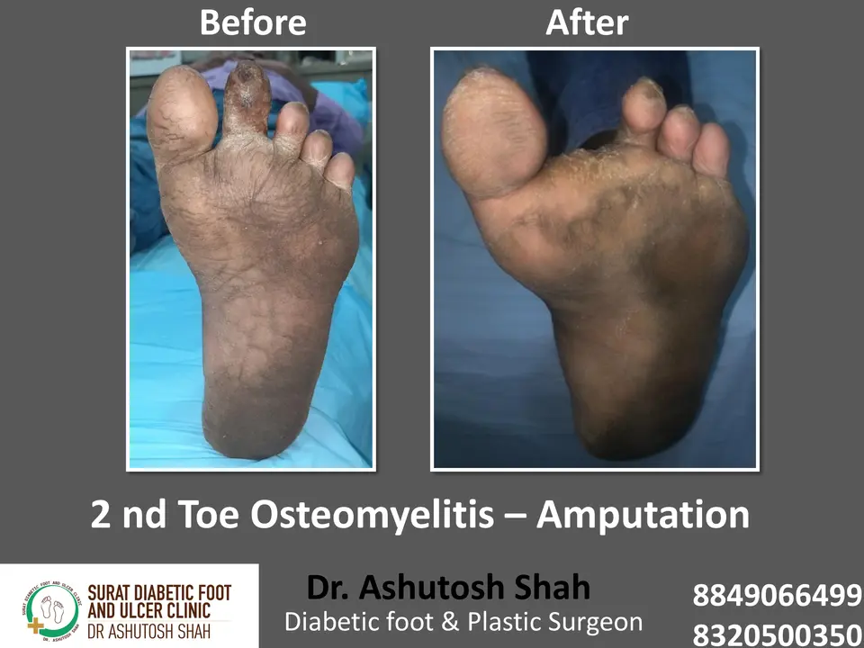 Diabetic Foot  PPT sunita.pptx-37.webp